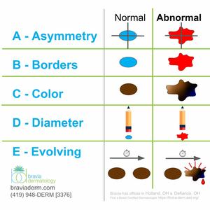 Easy as ABCDE (Melanoma features)