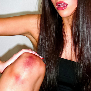 bruises
