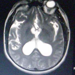 Worms SVCking Cankered Armpit