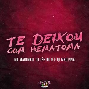 Te Deixou Com Hematoma