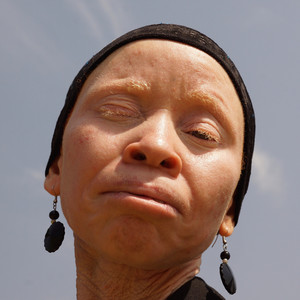 Albinism Unity (We Are Still Living In A Challenging World)
